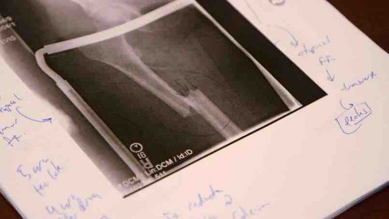 France 5 : leader du Prime TNT mercredi avec le documentaire «Ostéoporose : il y a comme un os»